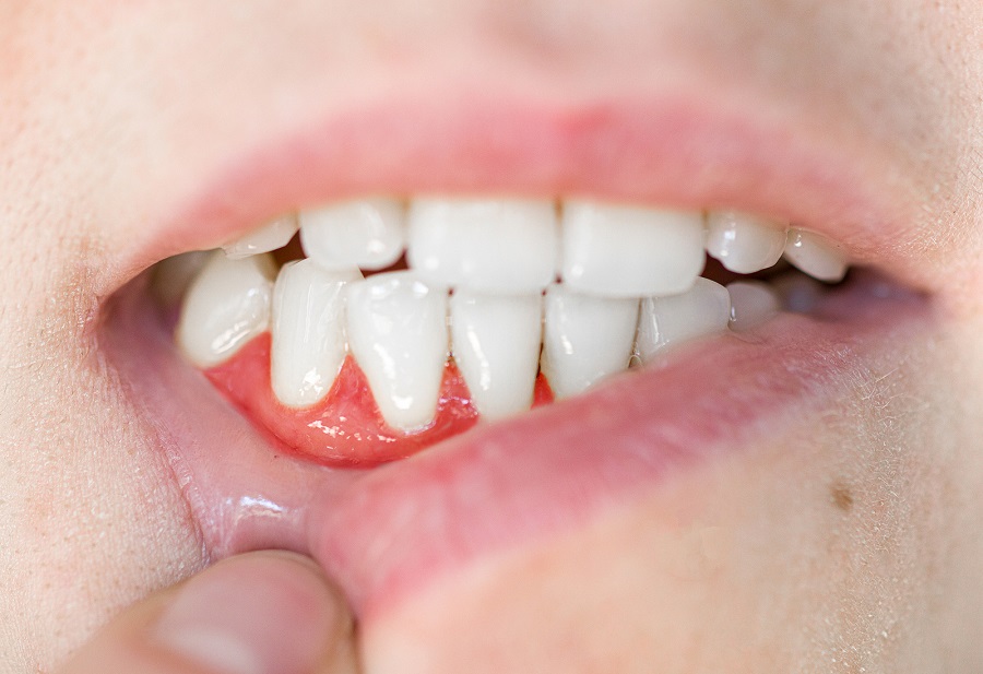 Periodontal (Gum) Disease