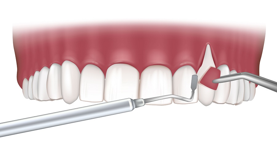 Soft Tissue Grafts or “Gum Grafts”