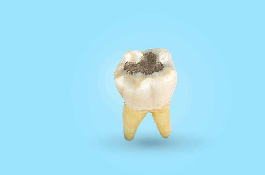 Amalgam Fillings