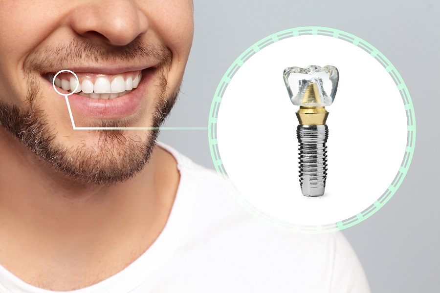 Dental Implants