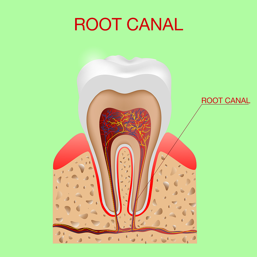Root Canal Therapy
