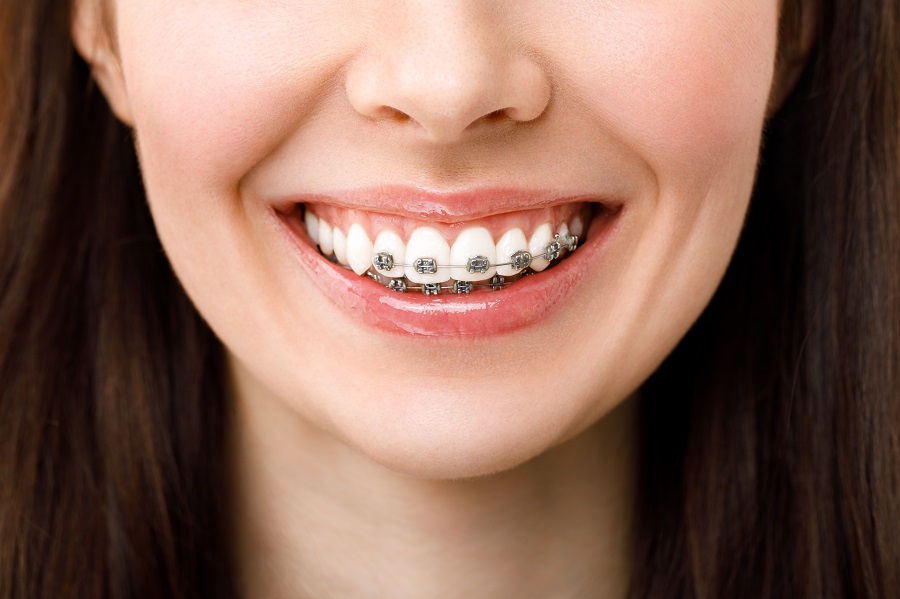 Braces