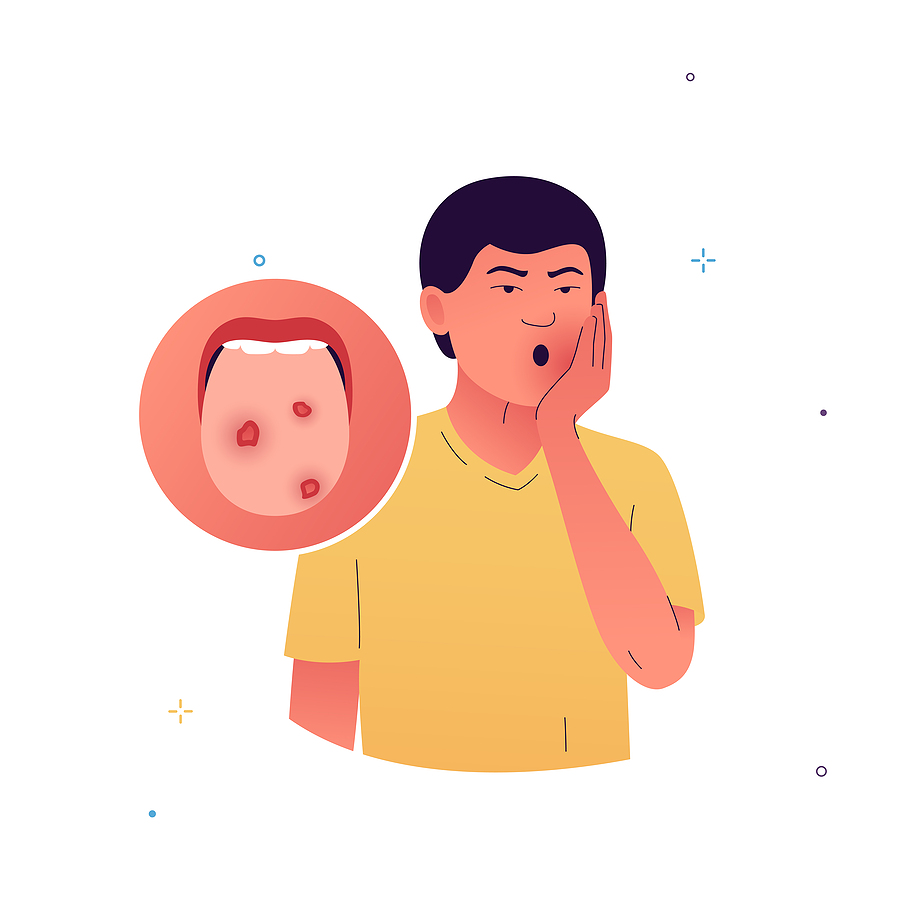 Mouth Ulcers
