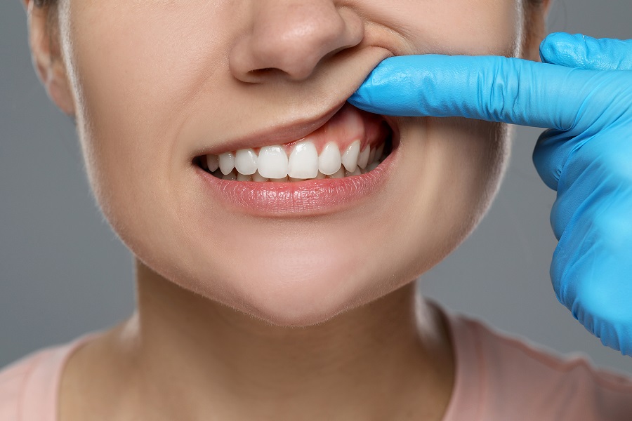 Osseous Grafts or “Bone Grafts”