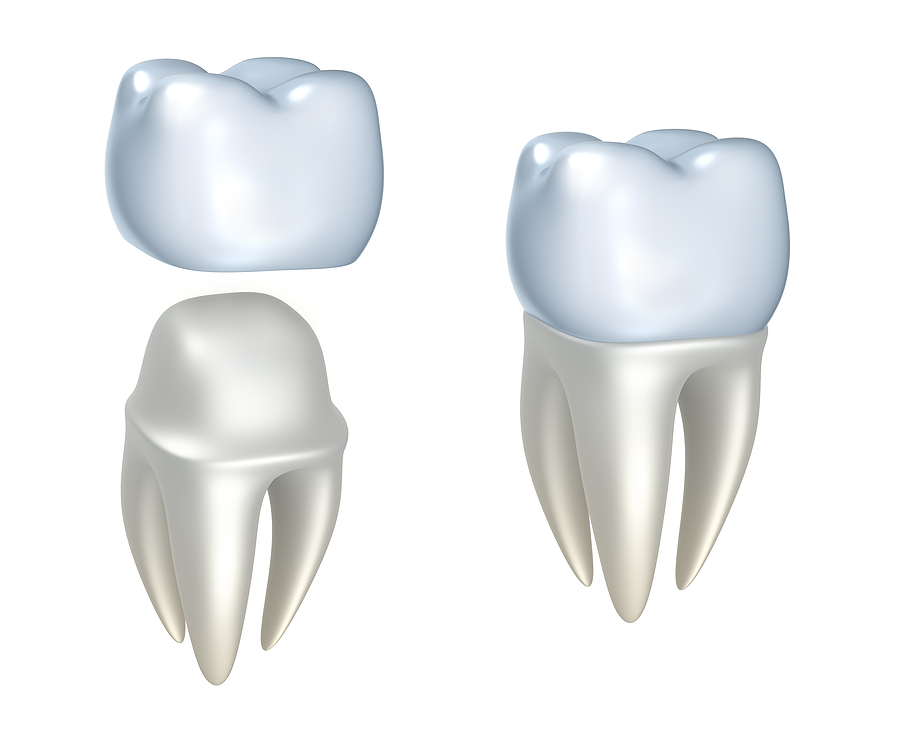 Restoring Your Smile with Dental Crowns in Jamaica, NY