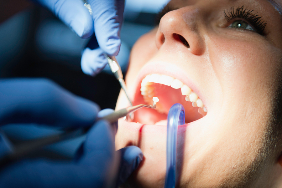 Everything You Need to Know About Dental Fillings in Jamaica, NY