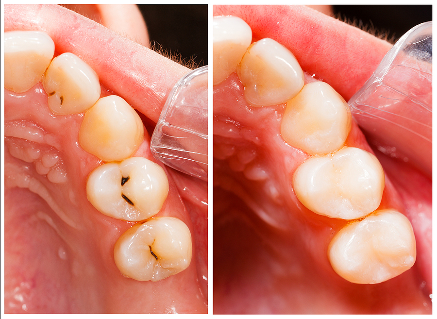A Complete Guide to Dental Fillings in Jamaica, NY: Restoring Your Smile and Oral Health