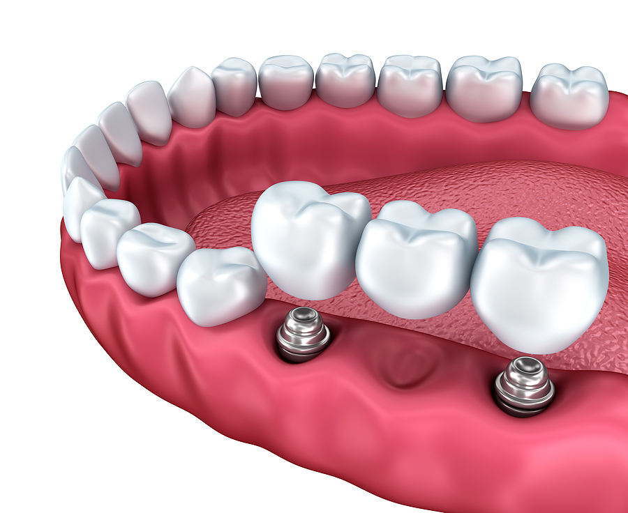 Restore Your Smile with Implant Restoration in Jamaica, NY