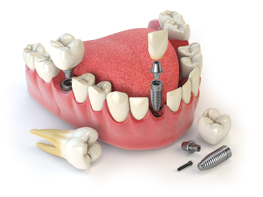 Restoring Your Smile: A Complete Guide to Implant Restoration in Jamaica, NY