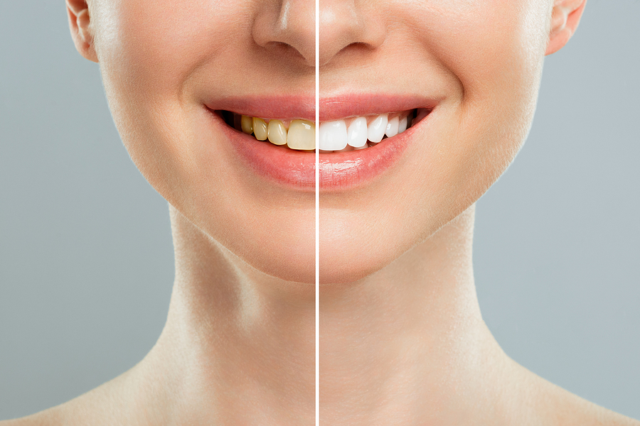 Achieve a Brighter Smile with Teeth Bleaching in Jamaica, NY